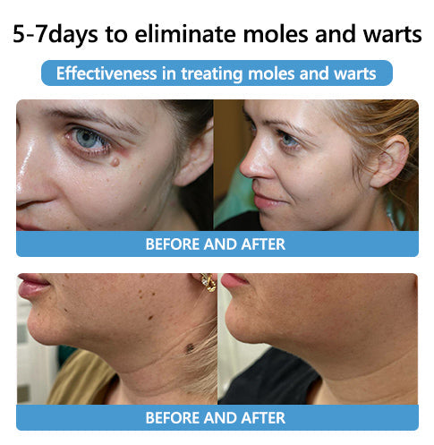 šLOVILDS⢠Bee Poison Mole and Wart Treatment Cream