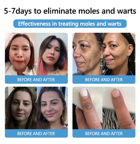 šLOVILDS⢠Bee Poison Mole and Wart Treatment Cream
