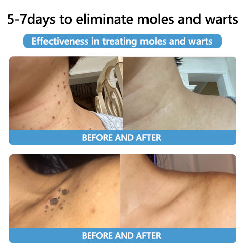 šLOVILDS⢠Bee Poison Mole and Wart Treatment Cream