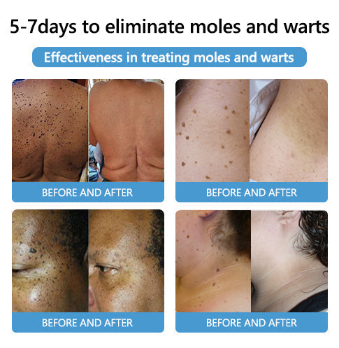šLOVILDS⢠Bee Poison Mole and Wart Treatment Cream