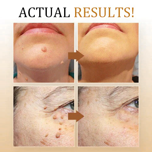 šLOVILDS⢠Bee Poison Mole and Wart Treatment Cream