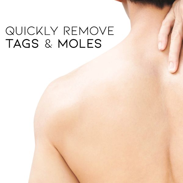 šLOVILDS⢠Bee Poison Mole and Wart Treatment Cream