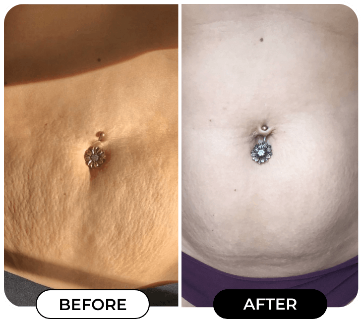 MINIYOU® B-FLAT Advanced Belly Firming Cream