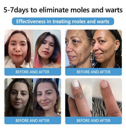 🐝LOVILDS™  Bee Poison Mole and Wart Treatment Cream