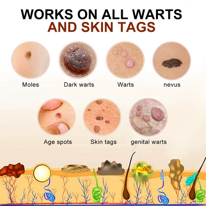 🐝LOVILDS™  Bee Poison Mole and Wart Treatment Cream