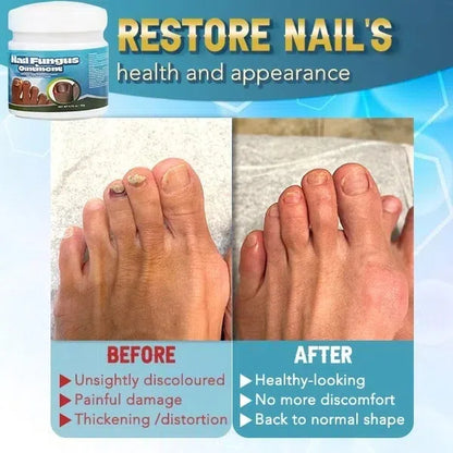 LOVILDS™ 5X Quick-healing Nail Fungus Ointment
