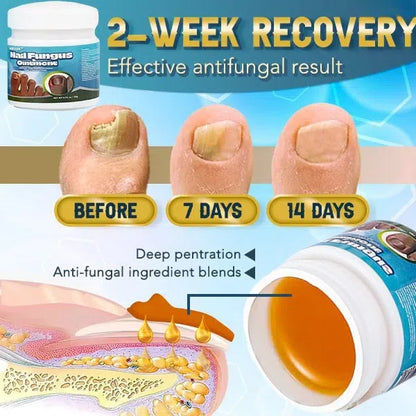 LOVILDS™ 5X Quick-healing Nail Fungus Ointment
