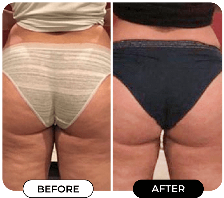 MINIYOU® B-FLAT Advanced  Belly Firming Cream