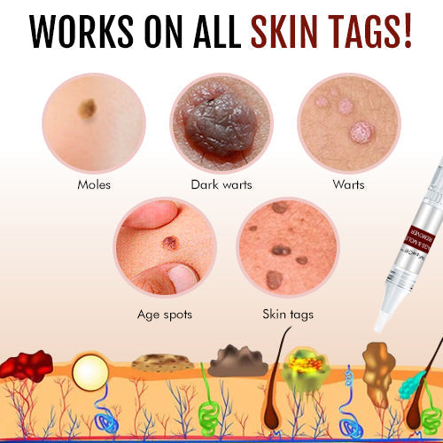 🎁Official Factory Direct Sales🎁LOVILDS™ Tags & Moles Remover
