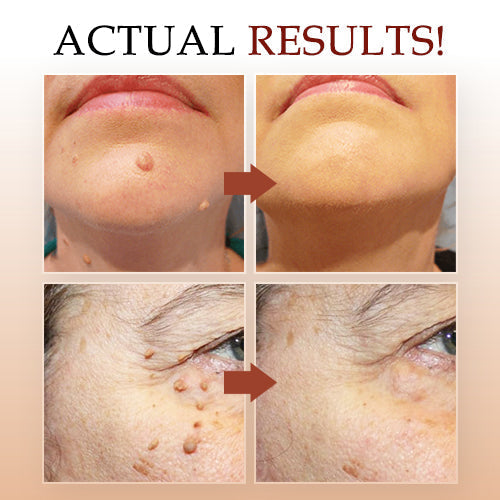 🎁Official Factory Direct Sales🎁LOVILDS™ Tags & Moles Remover